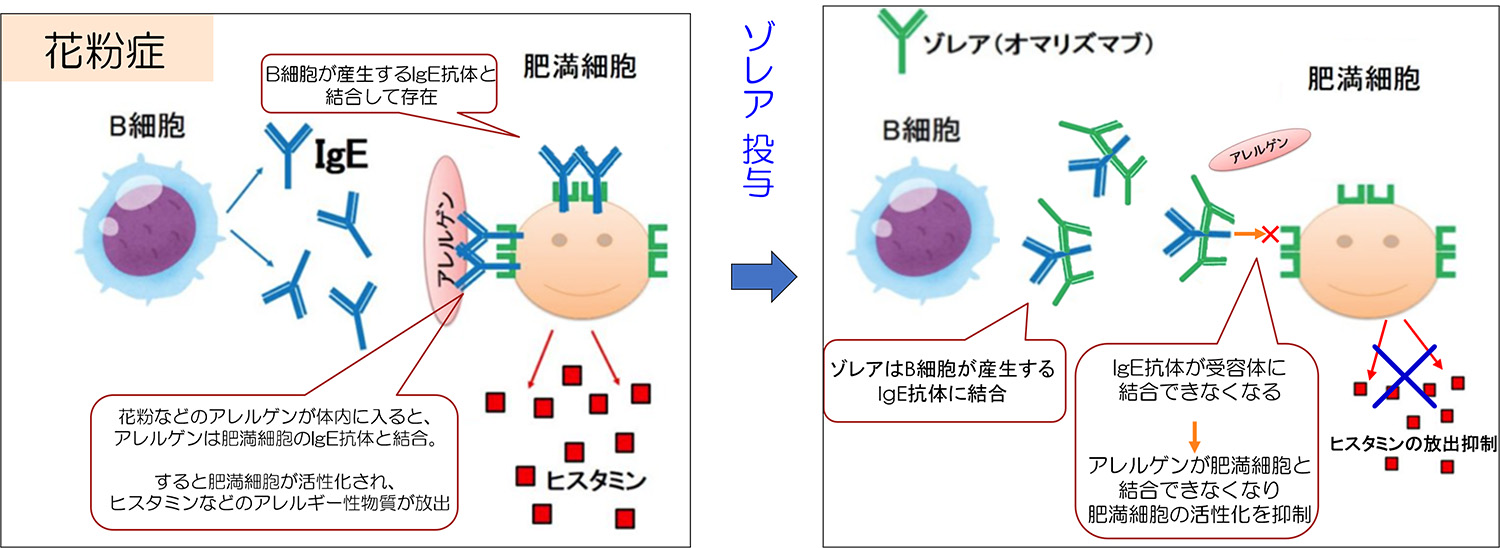 重症スギ花粉症に対する抗IgE抗体療法